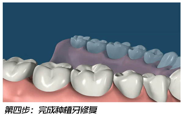 全面图解种植牙的过程